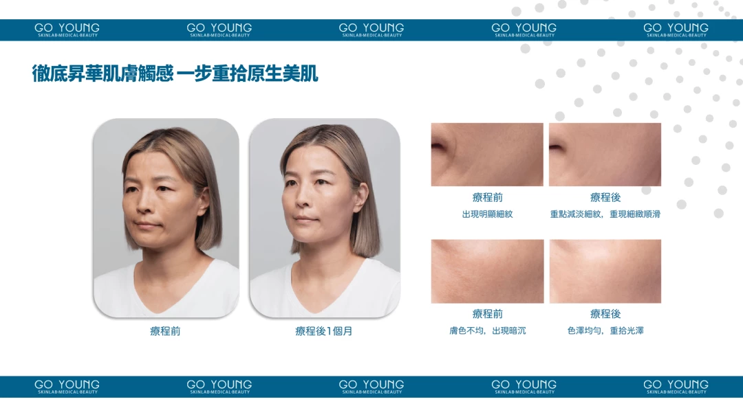 SKINVIVE®昇光針®
