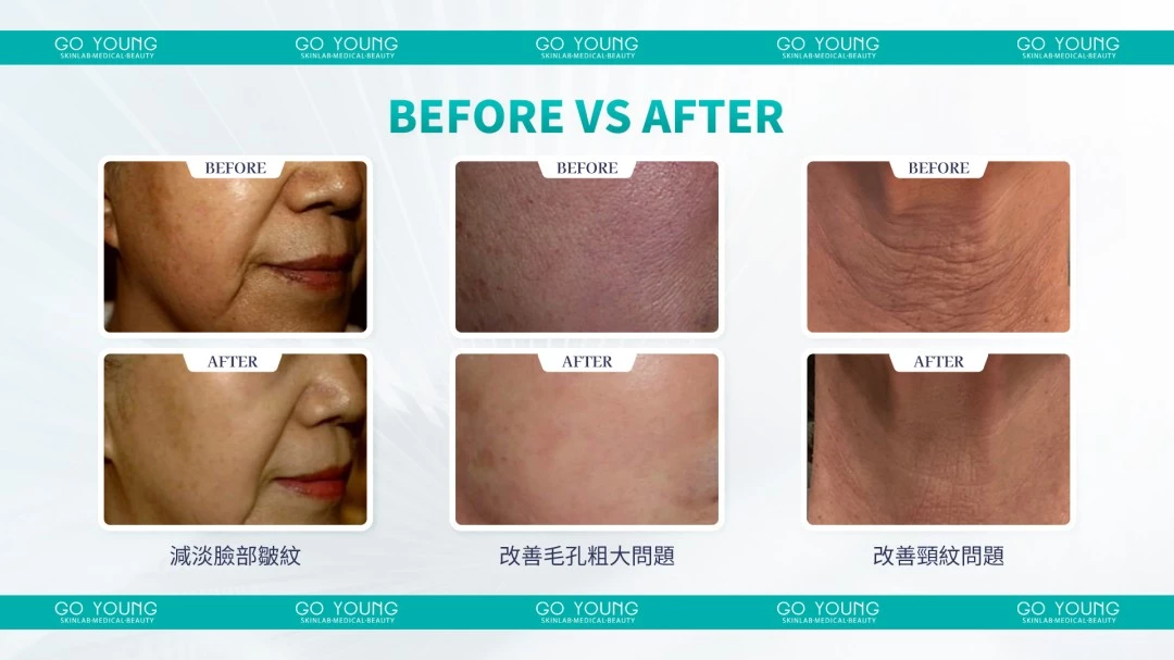 Rejuran® 麗珠蘭小黑盒