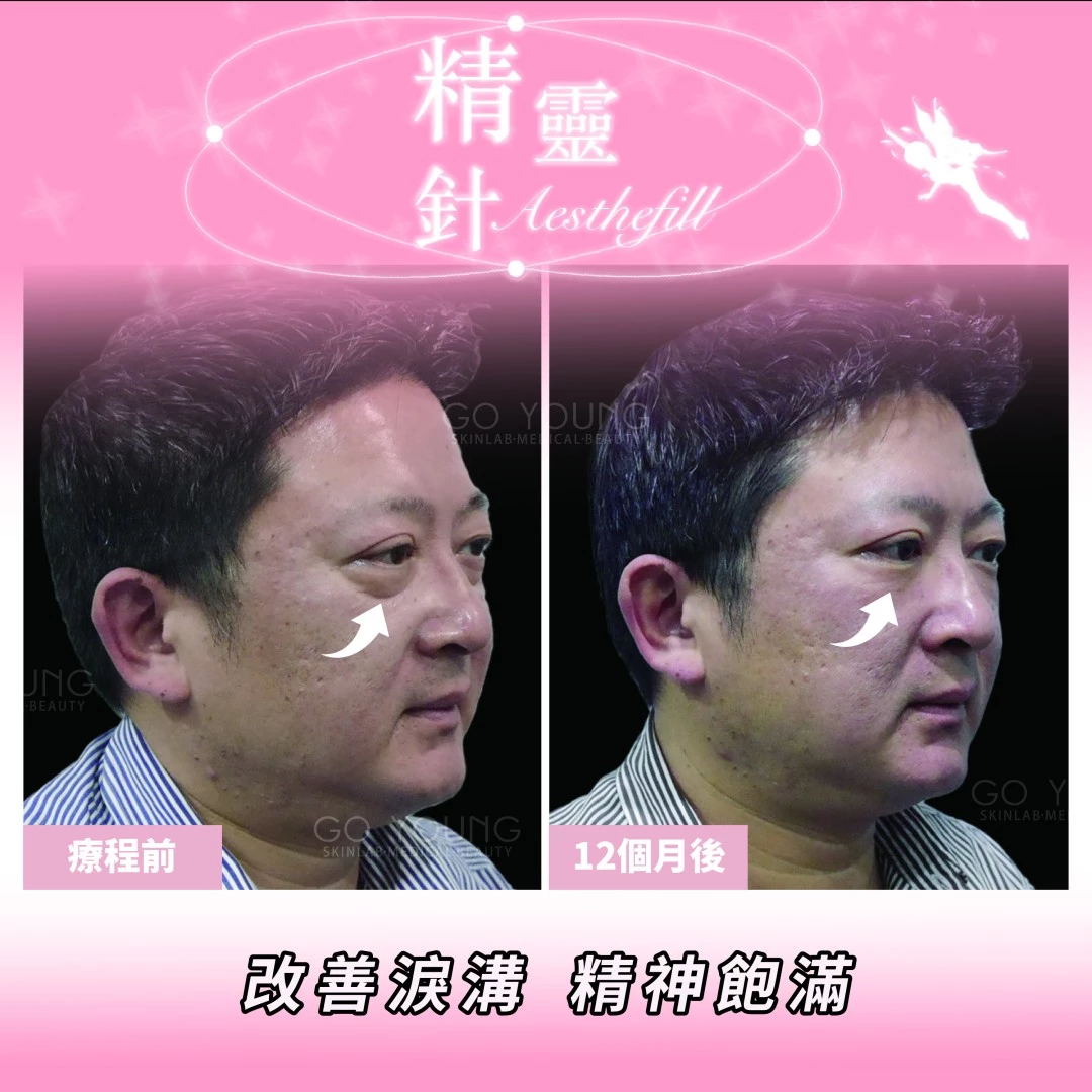 AestheFill 精靈針