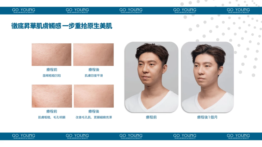 SKINVIVE®昇光針®