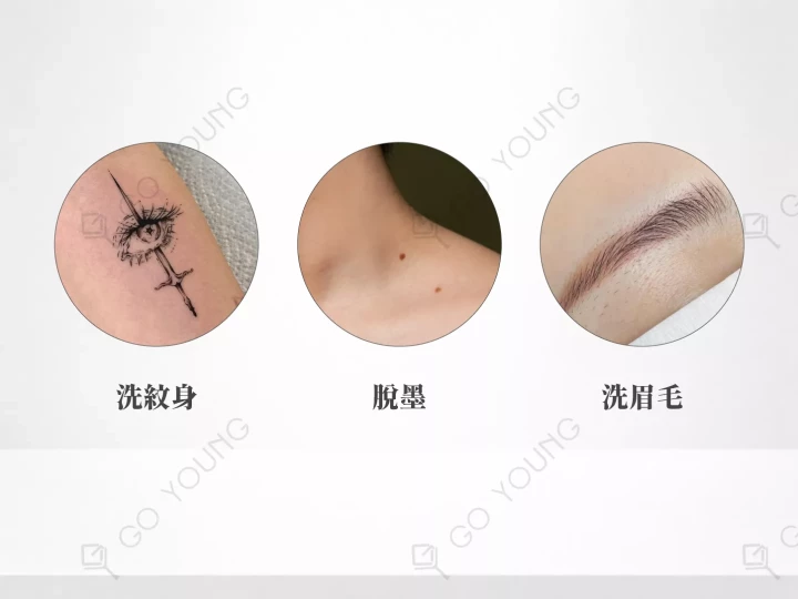 激光洗紋身／激光脫墨／洗眉毛療程