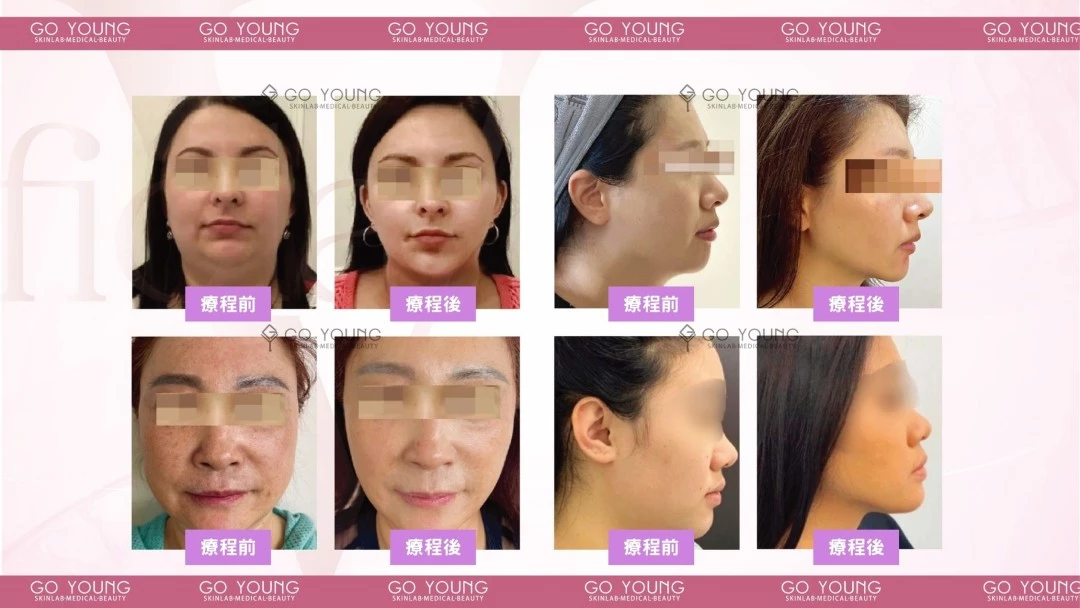 Fiola S 消脂針 (face & body)