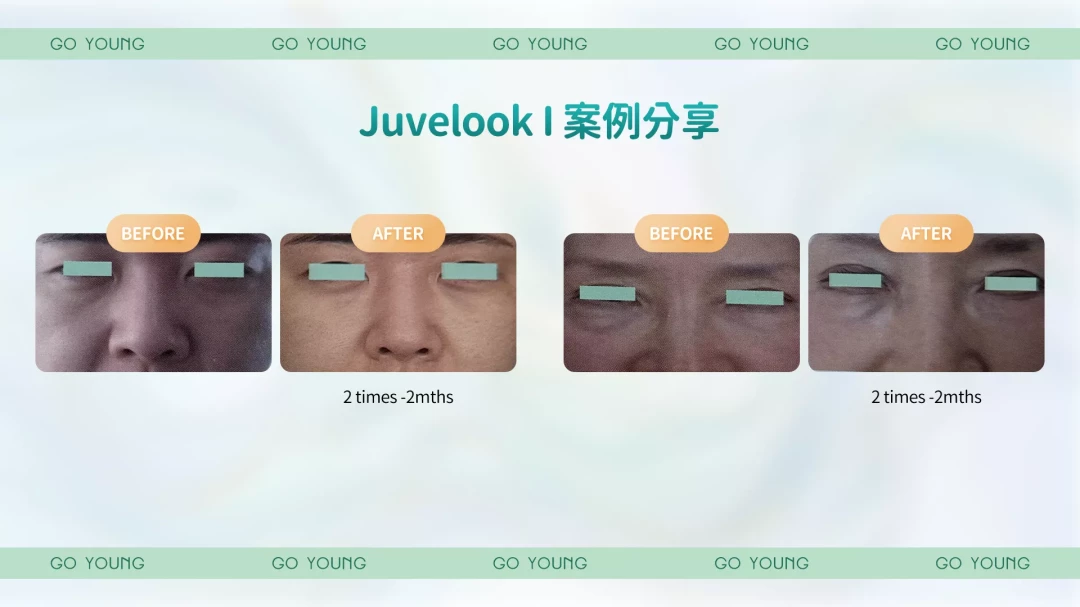 Juvelook I 綠瓶索眼針