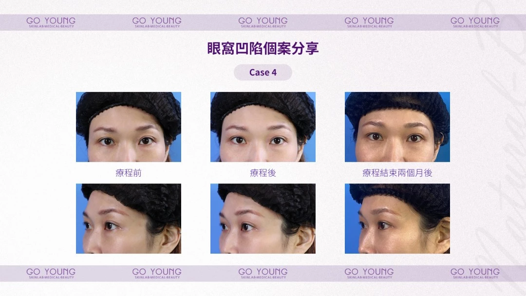 PROSTROLANE Natural B 膠原肽
