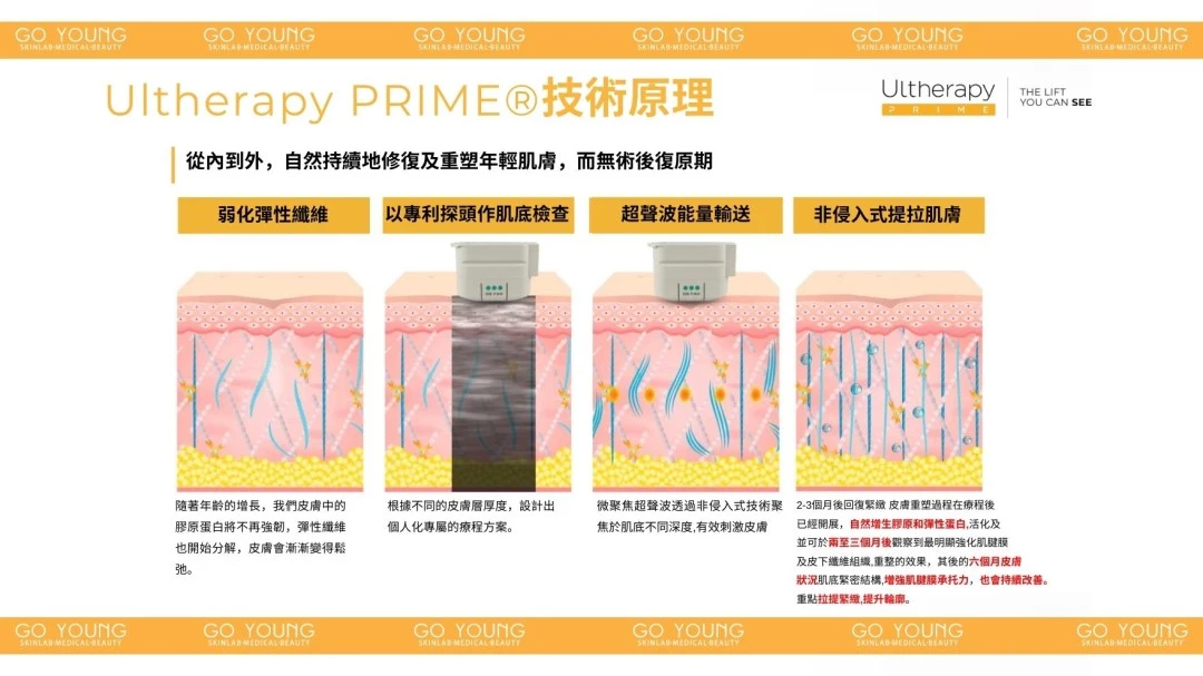 醫生主理 | Ultherapy PRIME® HIFU 二代 超聲刀療程