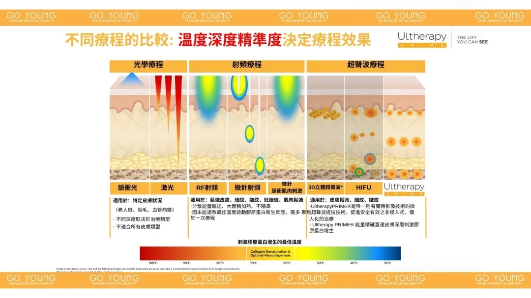 醫生主理 | Ultherapy PRIME® 二代 超聲刀療程