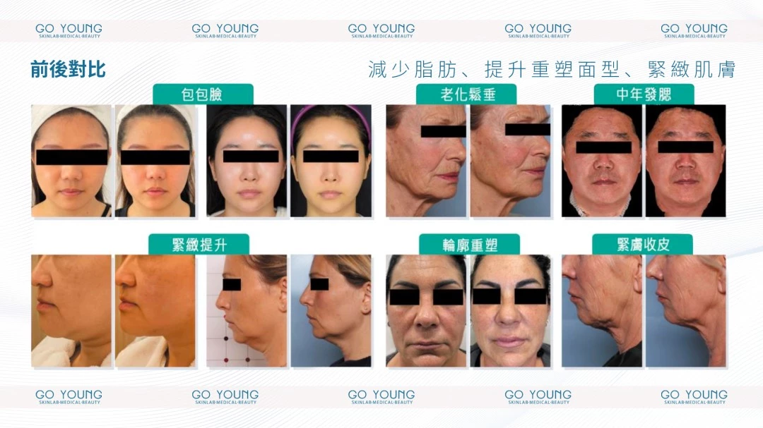 ONDA PRO 一叮溶脂