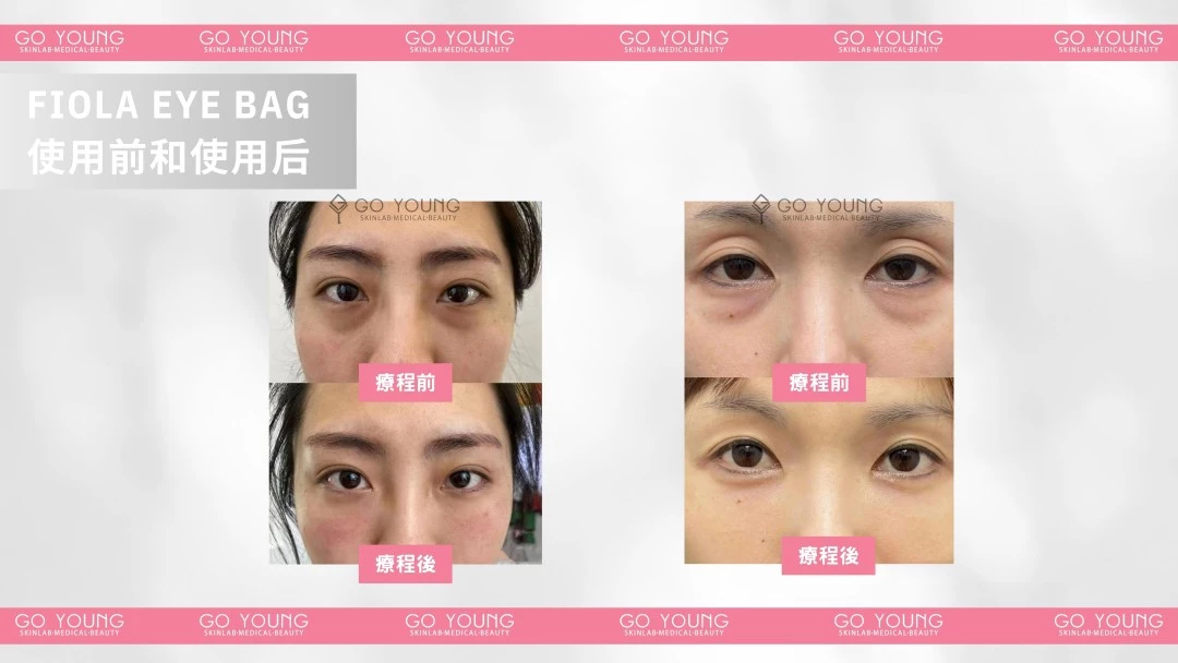 Fiola 眼袋針