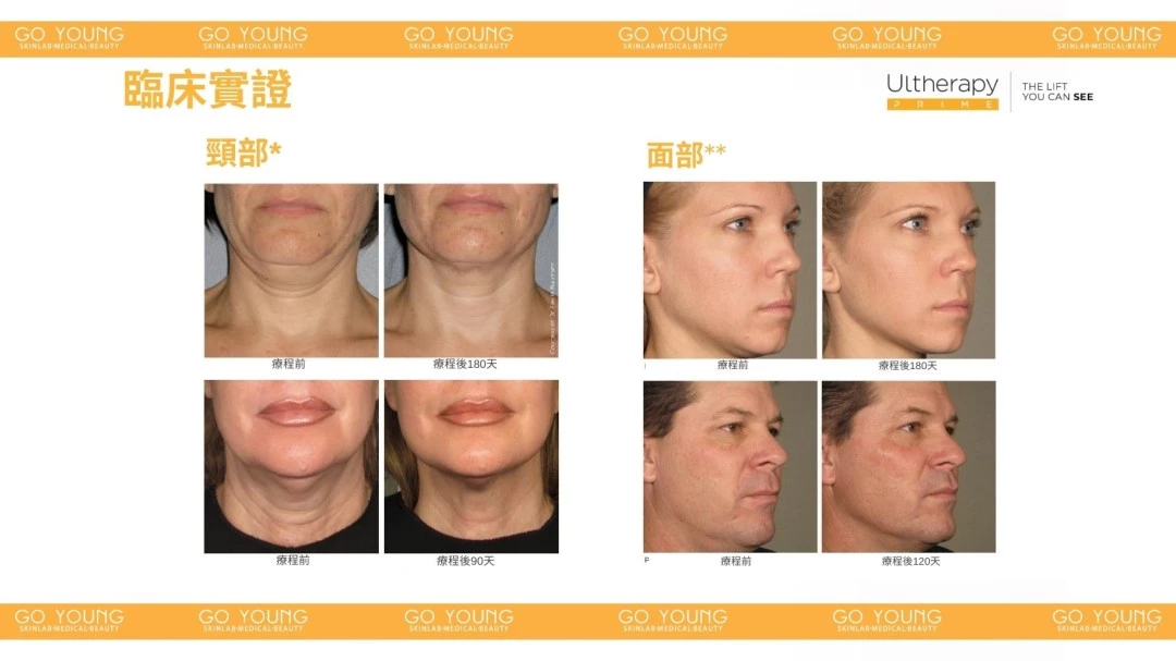 醫生主理 | Ultherapy PRIME® 二代 超聲刀療程