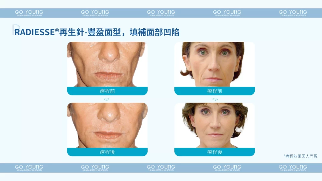 RADIESSE CaHA再生針 1.5cc