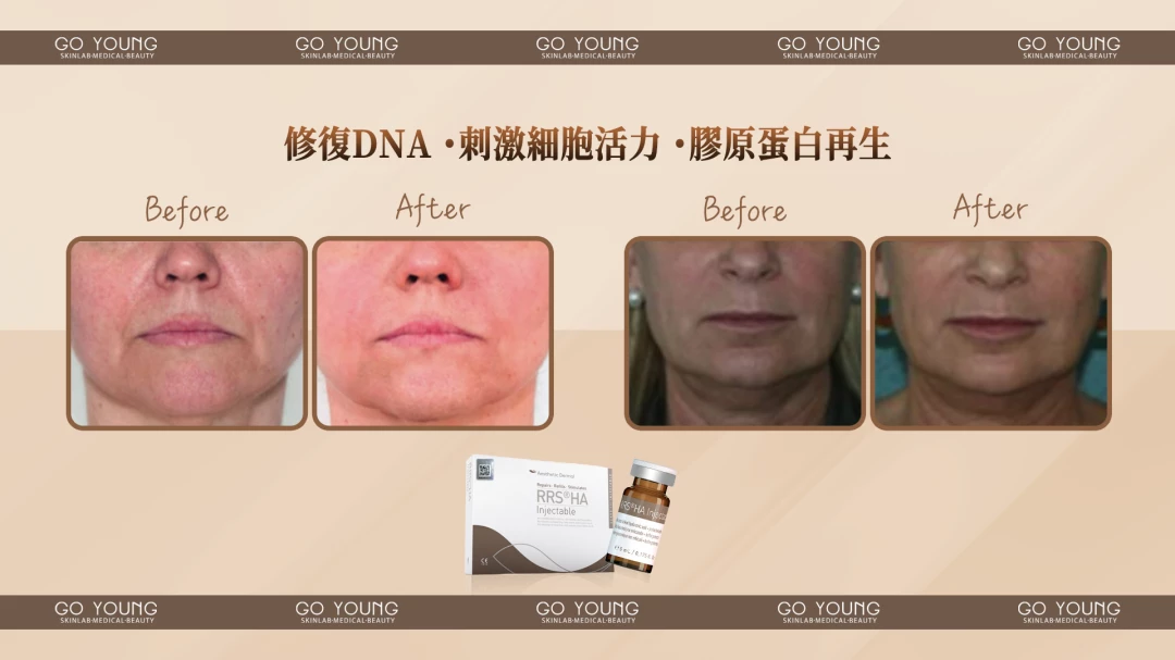 RRS® HA Injectable 營光針
