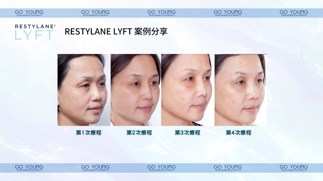 RESTYLANE® LYFT'™ with Lidocaine