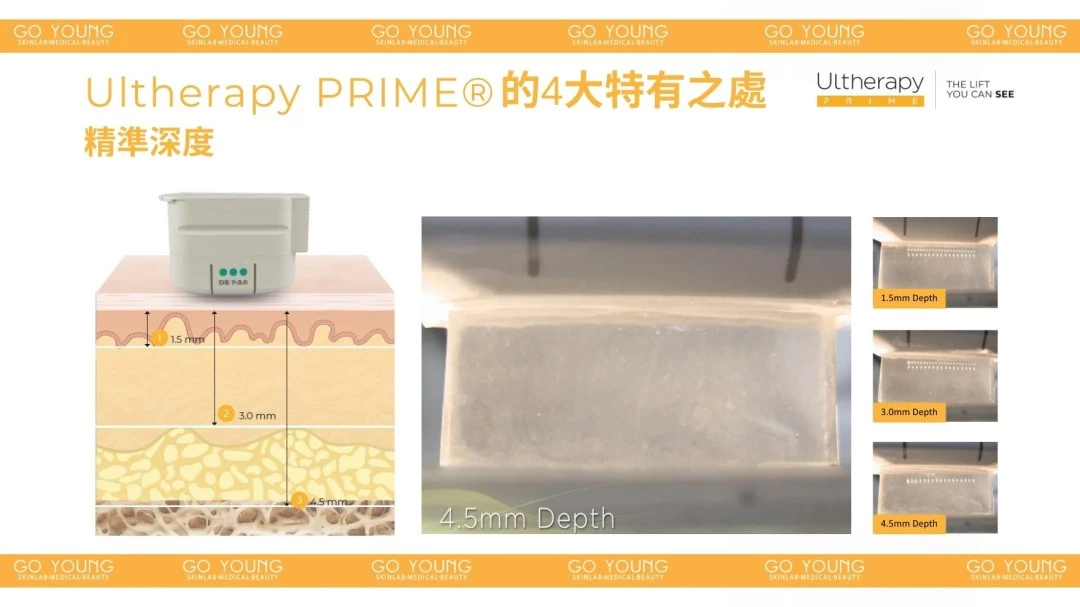 醫生主理 | Ultherapy PRIME® 二代 超聲刀療程